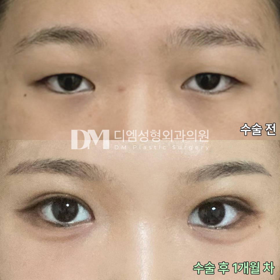 Blepharoplasty Review. "I’m satisfied because I think it will look very natural once all the swelling goes down!" image 2