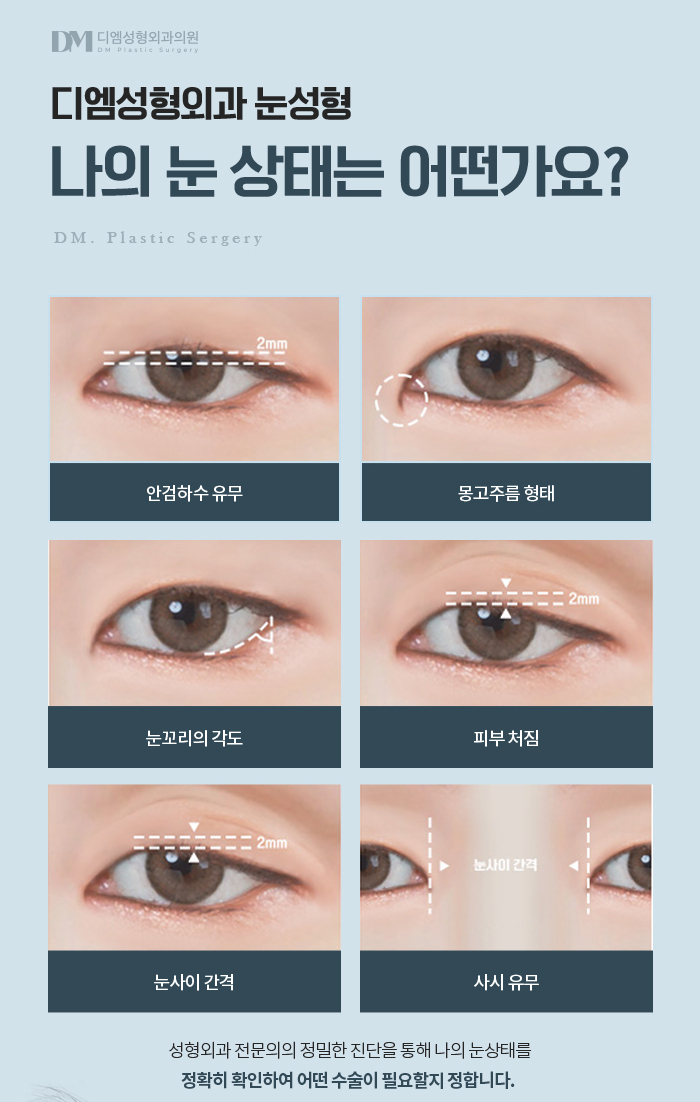 쌍꺼풀수술, 내 눈매에 맞는 자연스러운 라인으로 관련 이미지 4