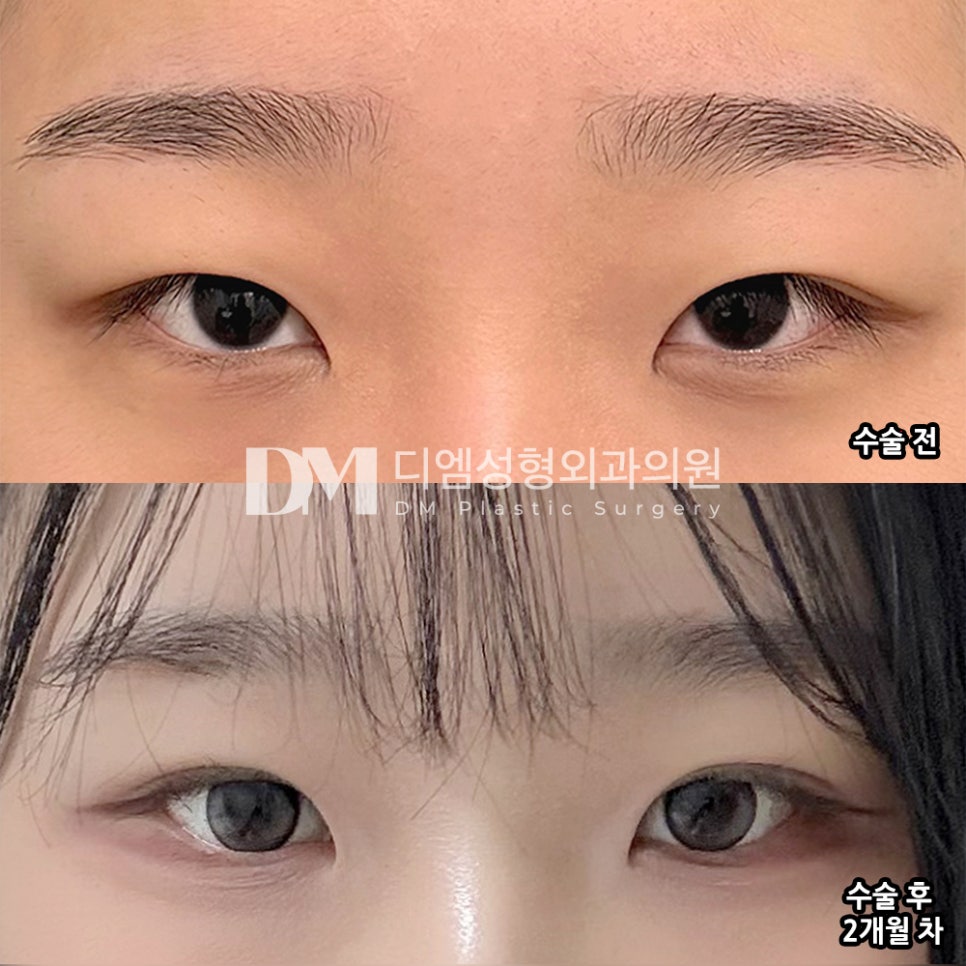 DM Eyelid Correction/Eye Plastic Surgery Review, “I’m very satisfied because the line has become incredibly natural!” image 2