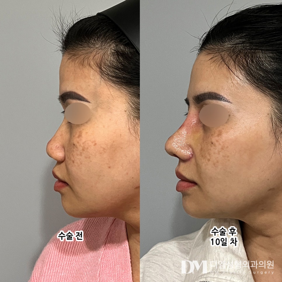 Low Nose Surgery: Never Forcefully Raise the Nose! image 8