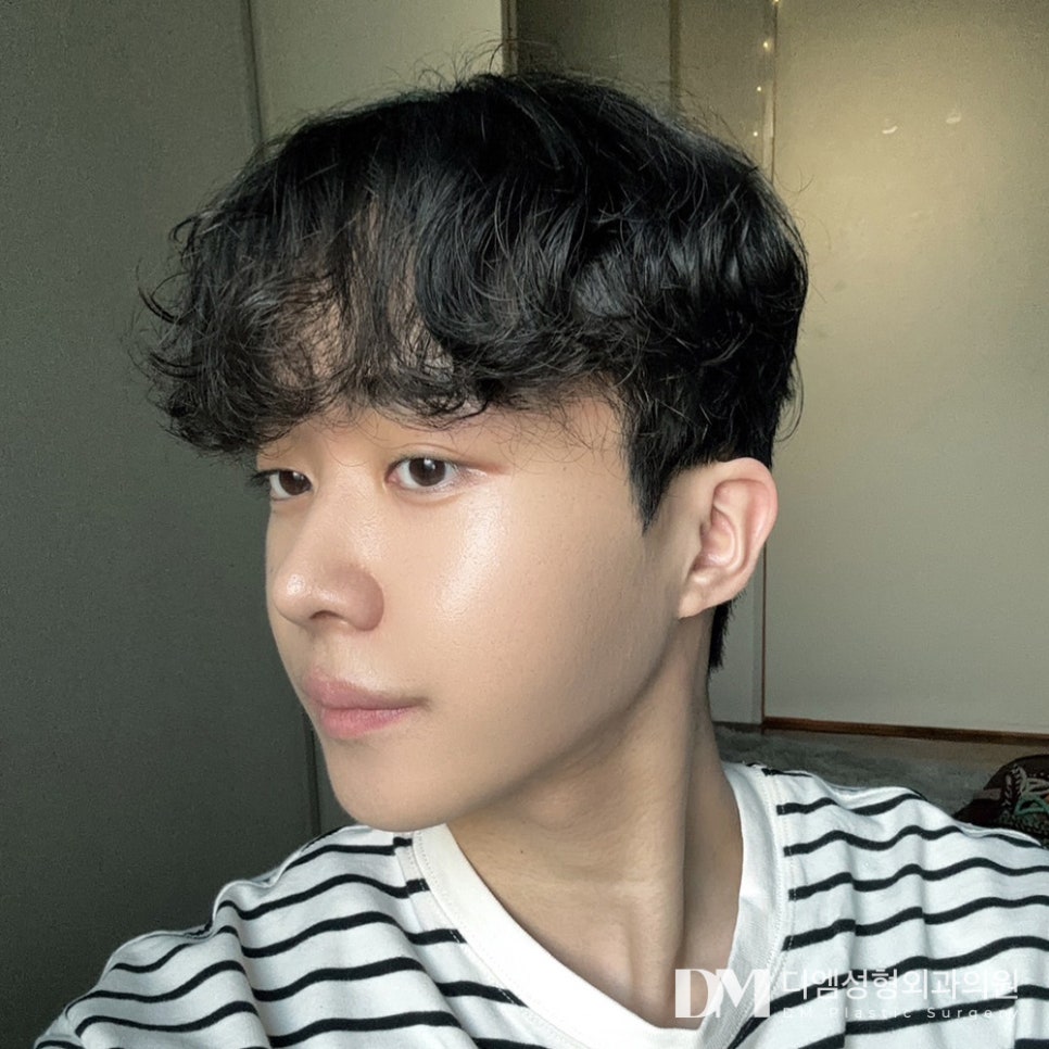 노화로 인해 자연스레 꺼지는 얼굴 볼륨, 얼굴지방이식으로 개선할 때! 관련 이미지 9
