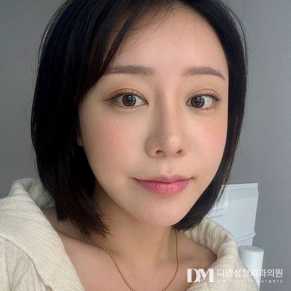 디엠 안면거상 전후사진, 탄력 잃고 늘어진 피부 되살리는 비결은? 관련 이미지 3