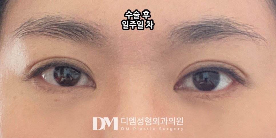 눈밑지방재배치, 칙칙하고 피곤해보이는 인상을 개선하려면?! 관련 이미지 7