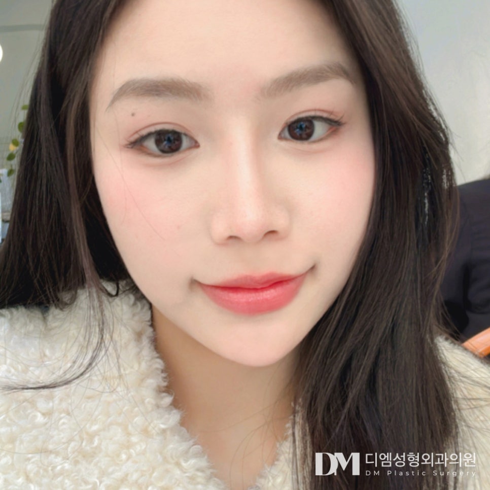 Double Eyelid Surgery: Which Line Suits My Eyes? image 14