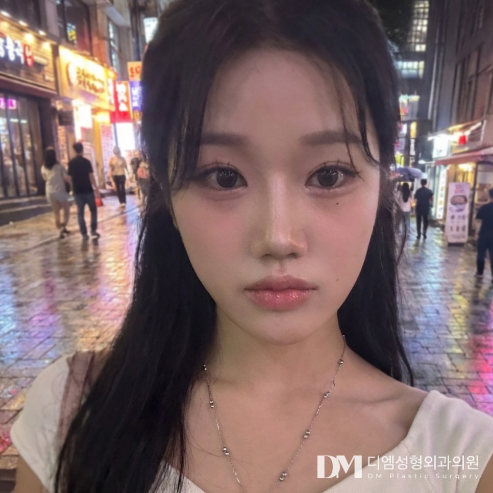 매부리코 성형, 자연스럽게 개선하기 위해서는? 관련 이미지 1