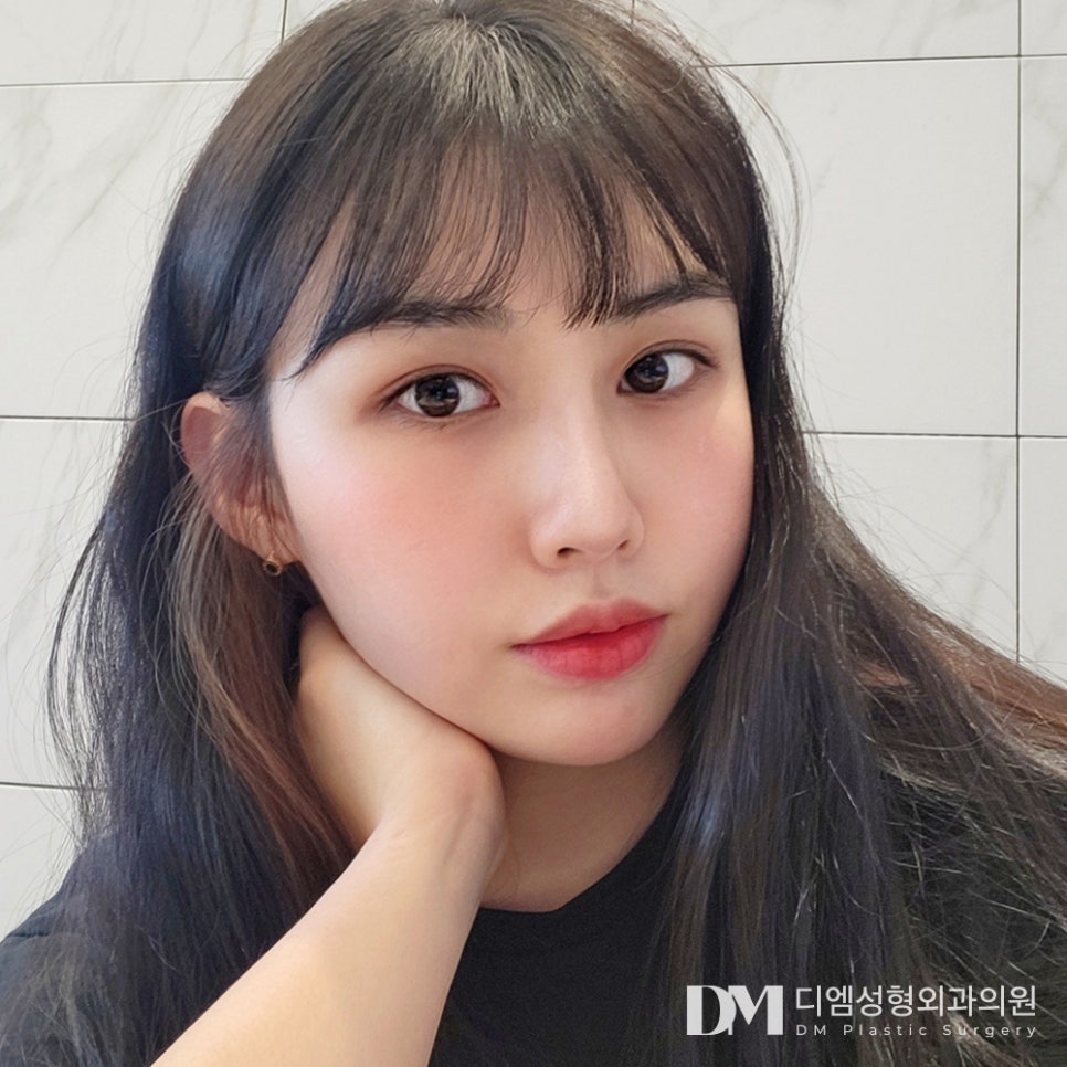 디엠 눈재수술 전후사진, 왜 더 신중해야 할까요? 관련 이미지 1