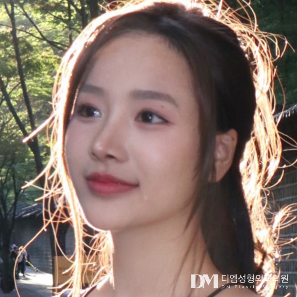 눈매교정, 자연스럽게 또렷해지기 관련 이미지 15