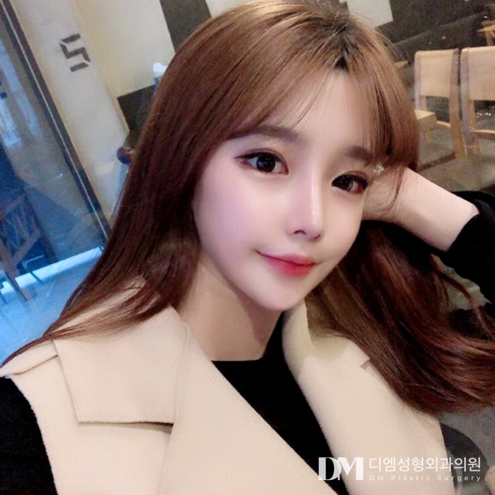 Tip Rhinoplasty: Moving Away from a Bulky, Unsophisticated Look! image 1