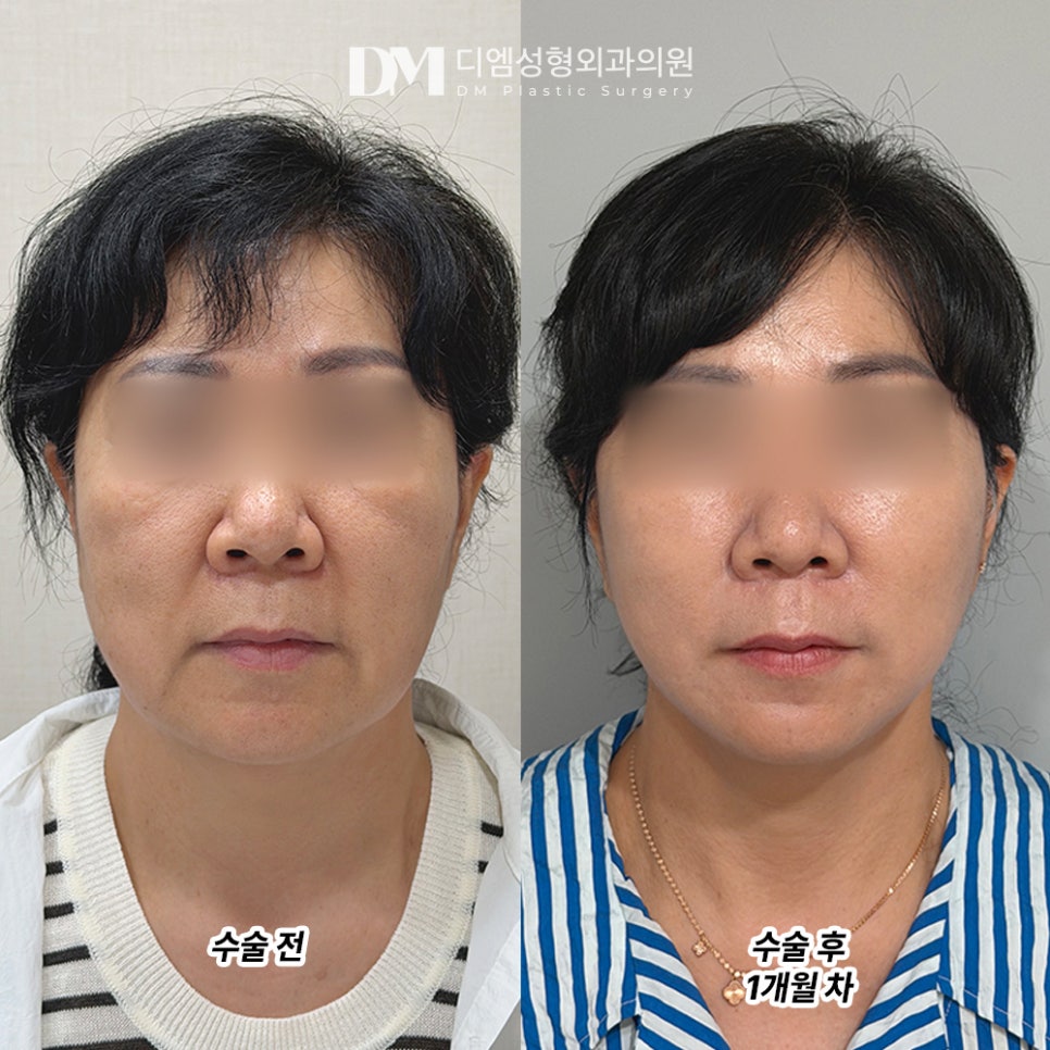 디엠 안면거상 전후사진, 처진 얼굴선의 변화를 확인해 보세요! 관련 이미지 2