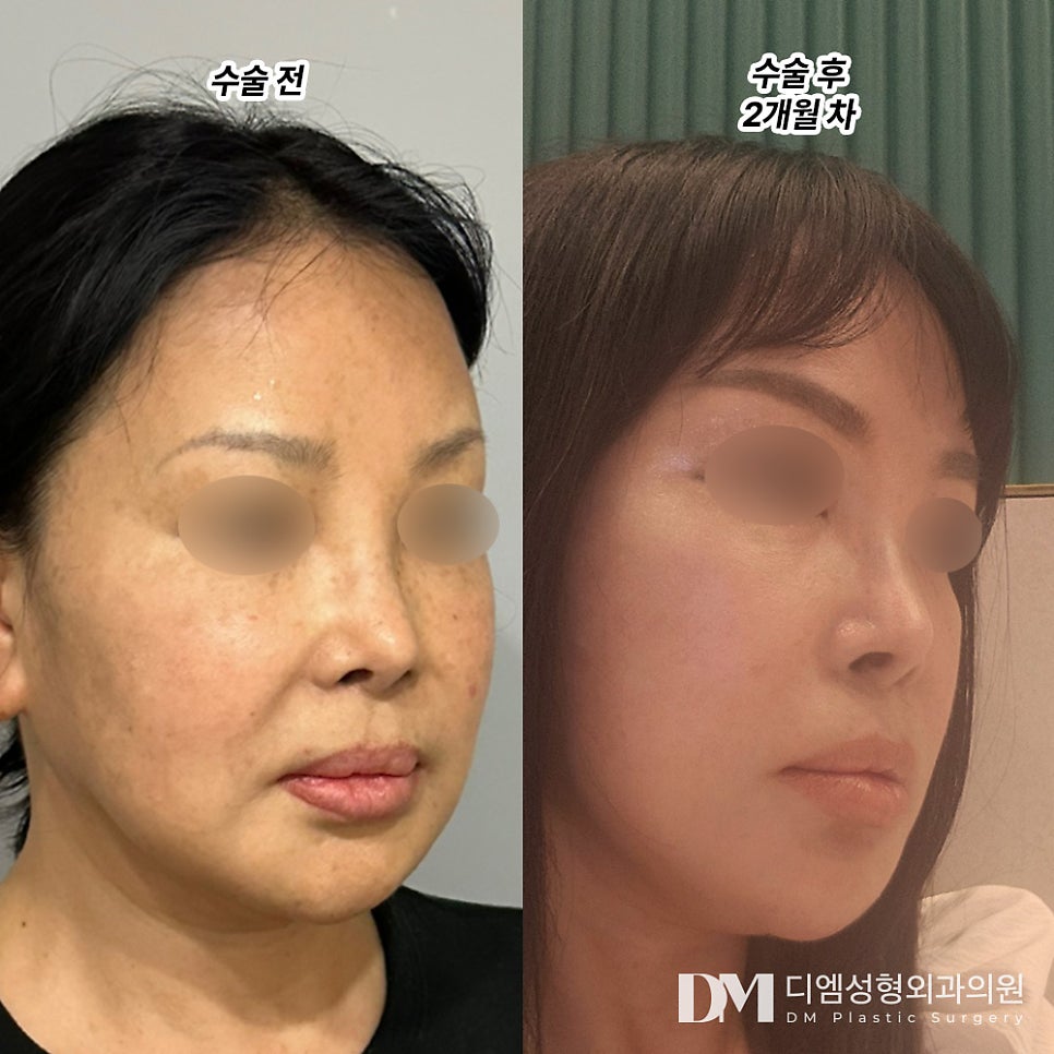 Facelift Review. “I’ve Gained Confidence When Meeting People!” image 2