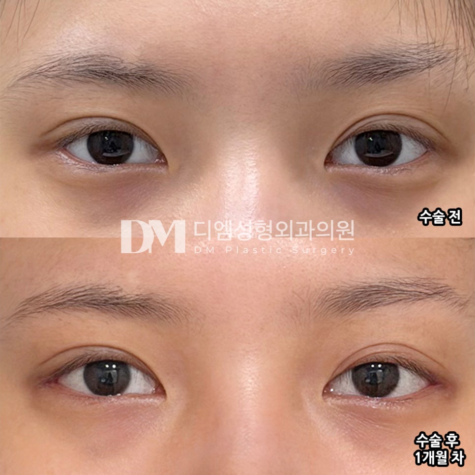 디엠 뒤밑트임/트임성형 후기, “전보다 훨씬 시원해 보여서 만족하고 있어요!” 관련 이미지 2