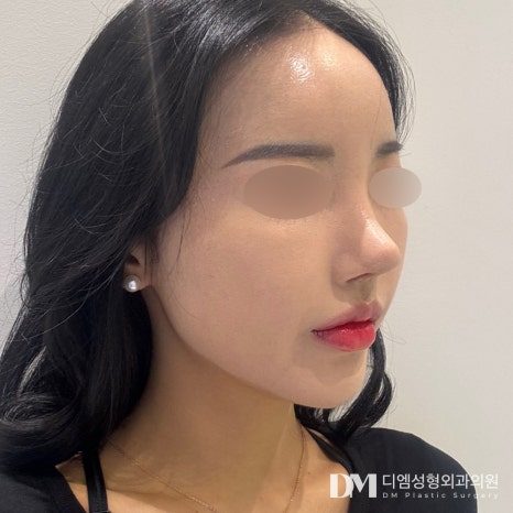 얼굴지방이식 후기."피곤한 인상이 좋아져서 만족이에요!" 관련 이미지 3