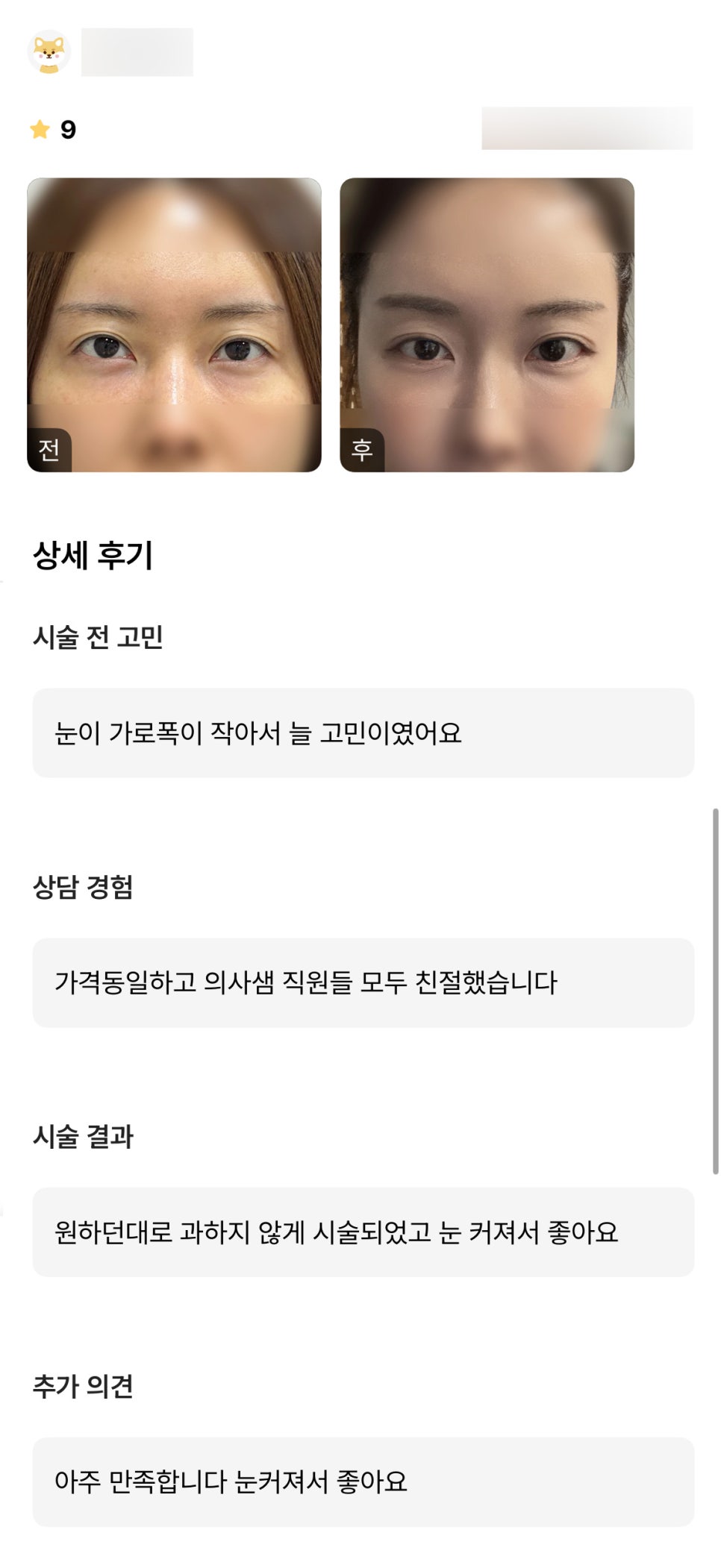 뒤밑트임 후기."과하지 않게 눈이 커져서 좋아요!" 관련 이미지 1
