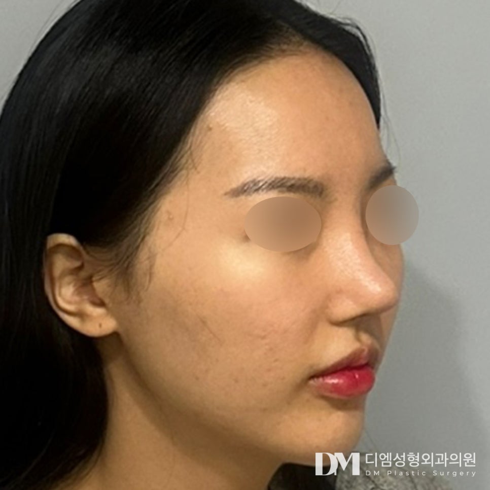 A Flat Facial Contour Transformed into a Three-Dimensional Look with Facial Fat Grafting! image 6