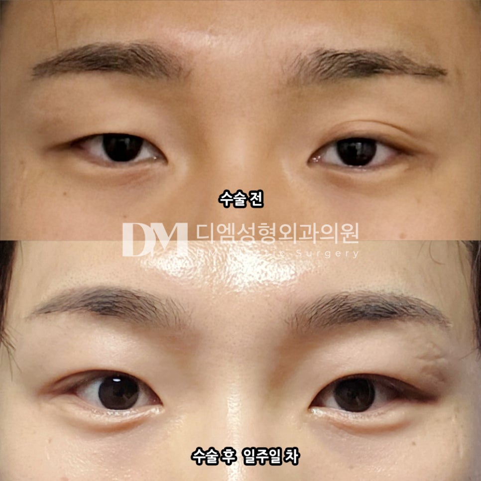 Eyelid Surgery Review. “I was amazed at how quickly I recovered, and I’m very satisfied!” image 2