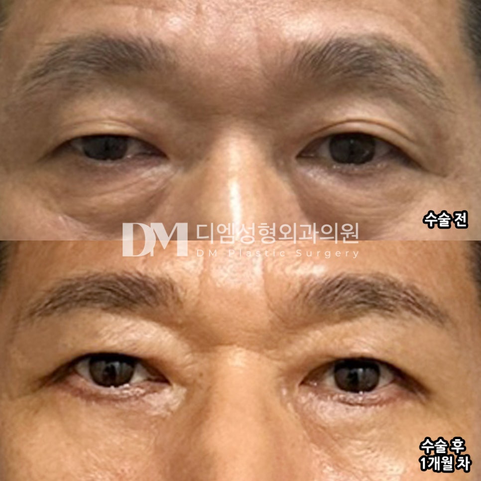 눈이 처져 답답한 시야, 상안검으로 해결 ! 관련 이미지 11