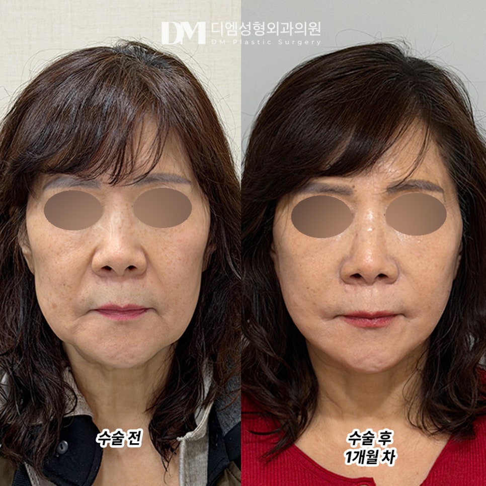 DM Facelift Before-and-After Photos: A Noticeably Changed Jawline at a Glance image 2
