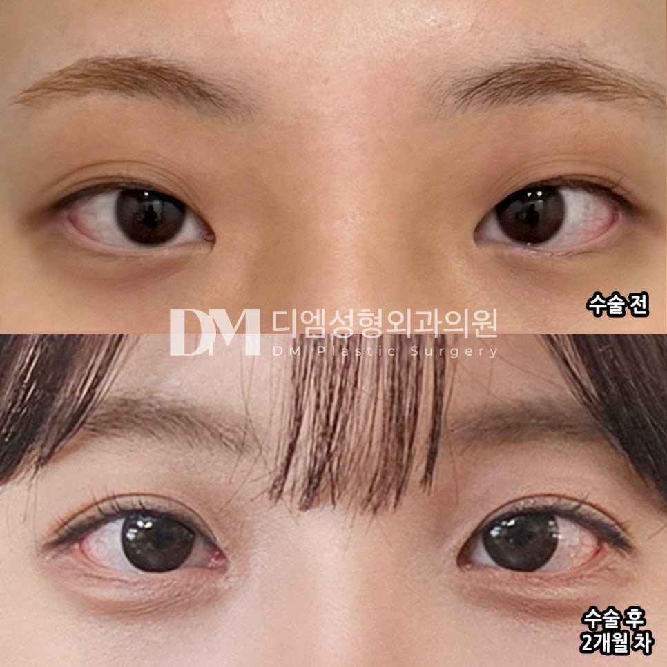 DM Eye Correction/Epicanthoplasty Surgery Review, “I’m So Satisfied with the Line!” image 2