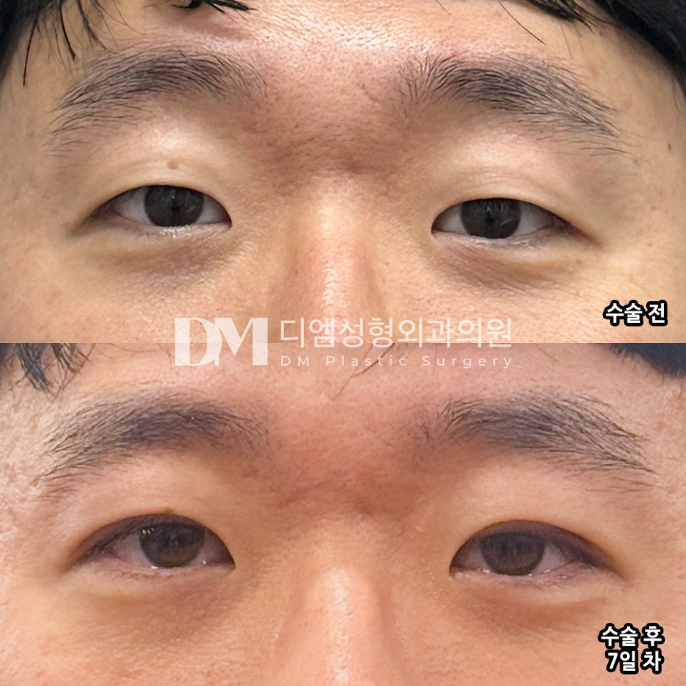 눈성형 후기."강추합니다!" 관련 이미지 2
