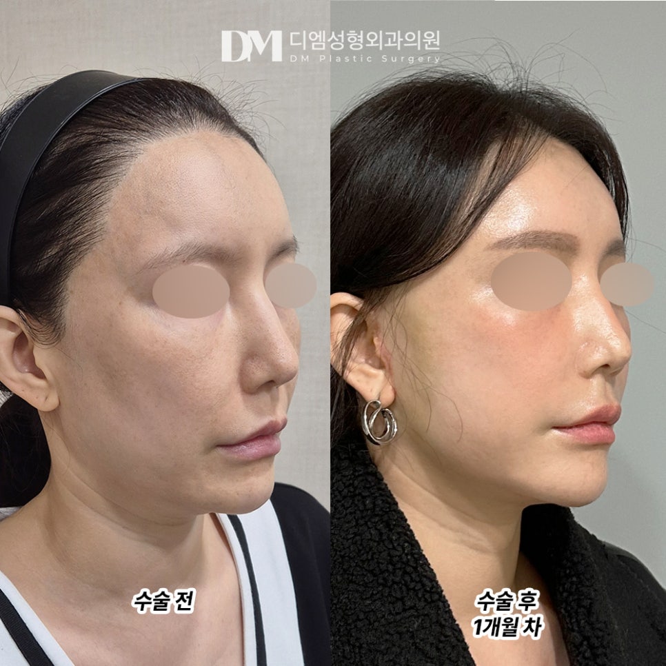 디엠 안면거상 전후사진, 잃어버린 젊음을 되찾을 수 있는 리프팅 관련 이미지 3