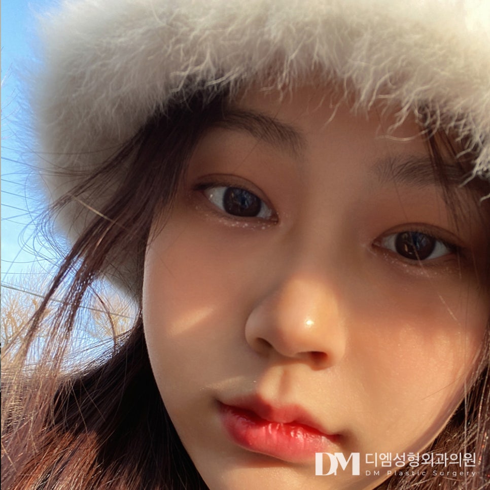 눈밑지방재배치 ,울룩불룩하고 칙칙한 눈밑이 고민이라면? 관련 이미지 1