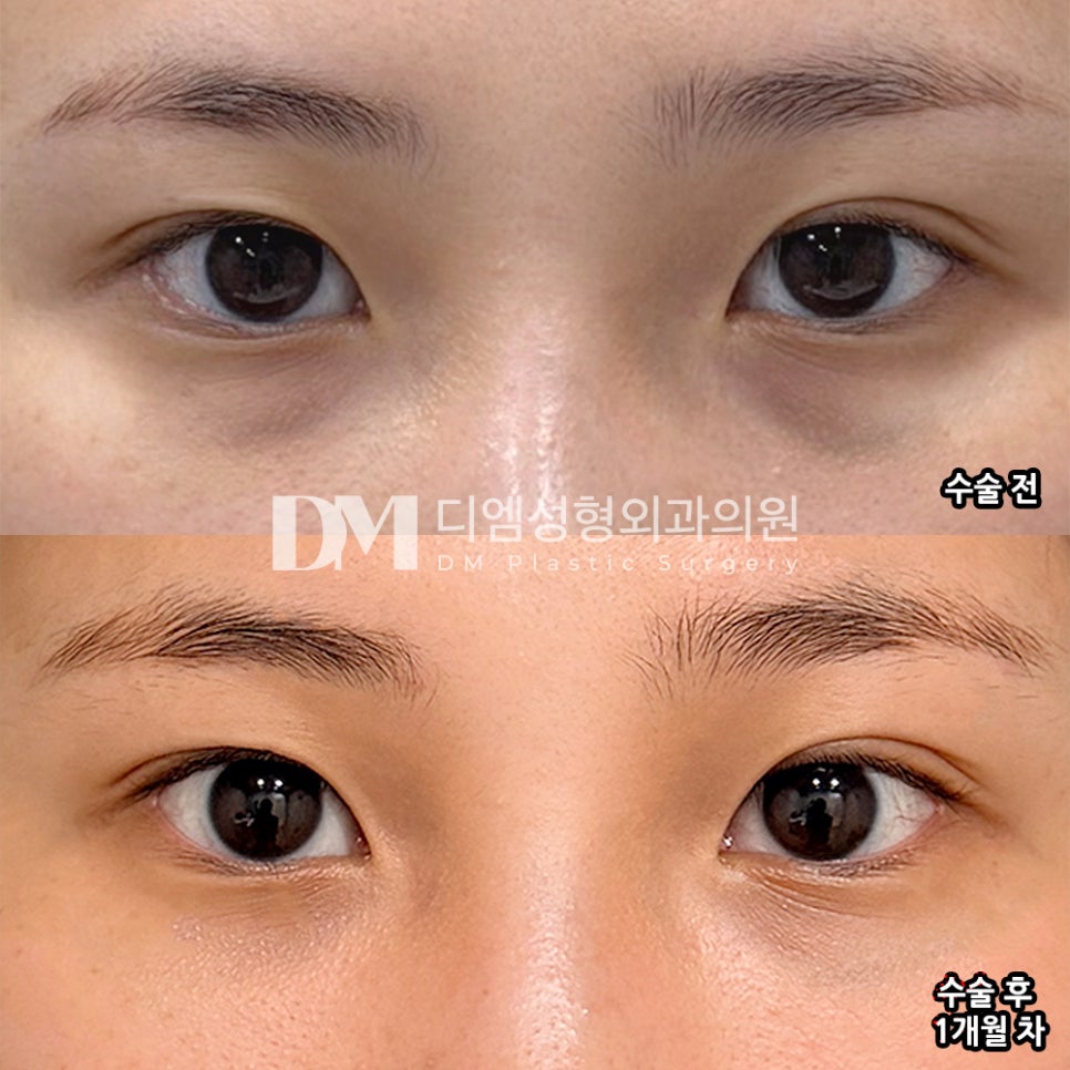 DM Lower Eyelid Fat Repositioning Before & After Photos: Making Deeply Hollow Lower Eyelids Brighter and Smoother! image 2