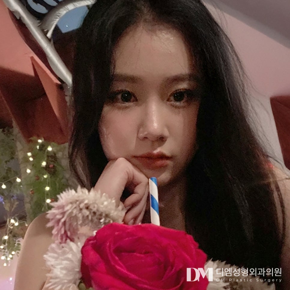 디엠 눈밑지방재배치 전후사진, 화장으로 가려지지 않는 눈 밑 개선 완료! 관련 이미지 3