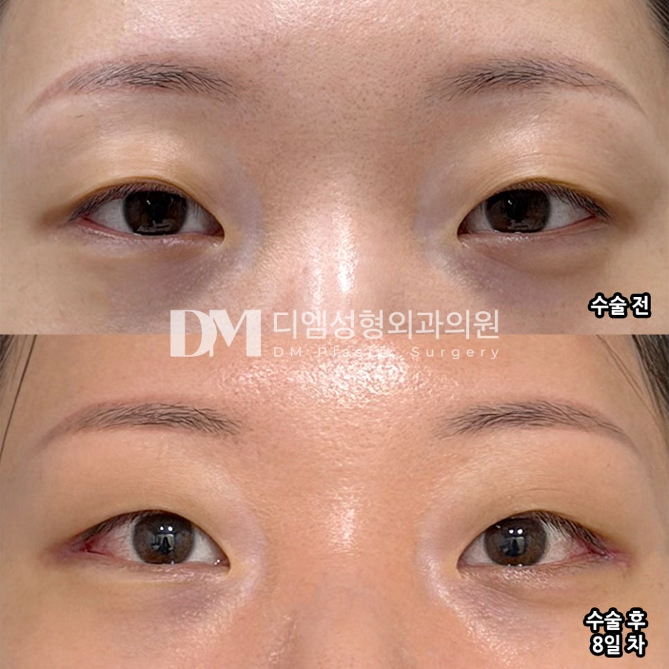 DM Posterior and Lower Canthoplasty Surgery Review, “I’m So Satisfied After the Surgery!” image 2