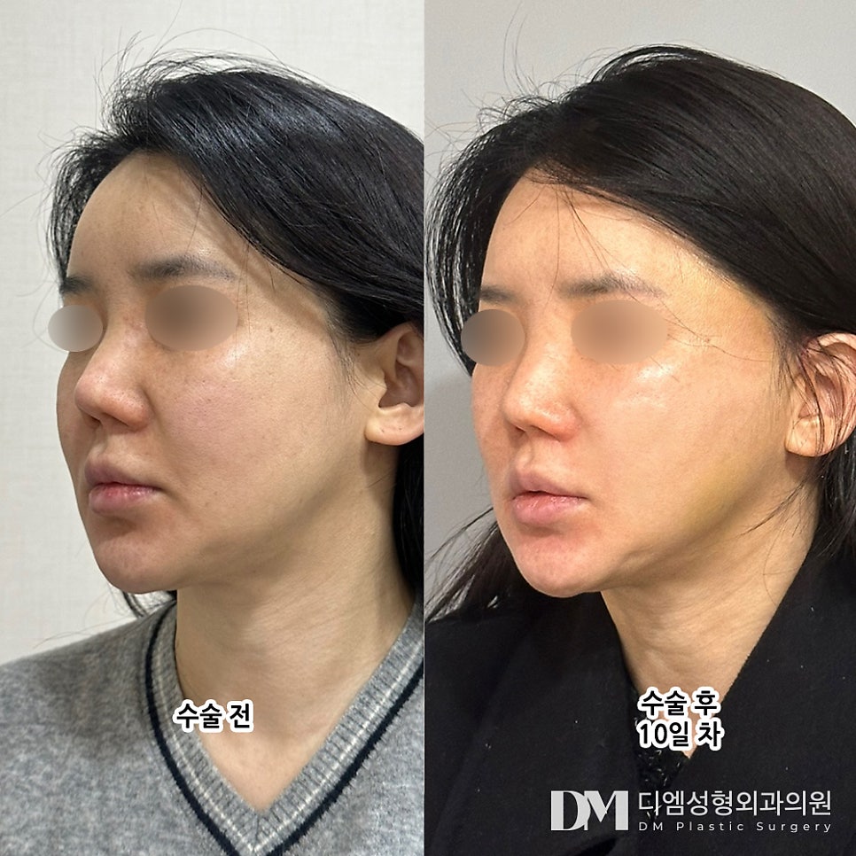 Mini Facelift Review: “It really seems important to have the procedure performed by a doctor with extensive experience!” image 2