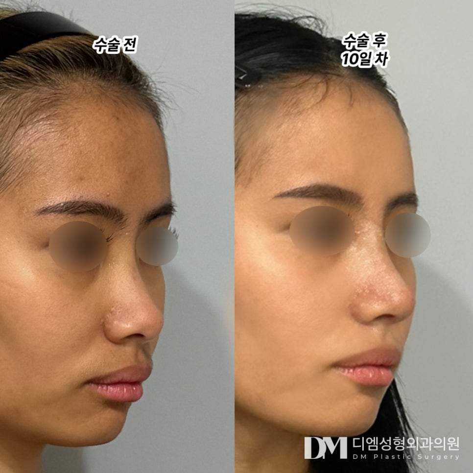 Low Nose Rhinoplasty, Goodbye to a Flat Impression! image 8
