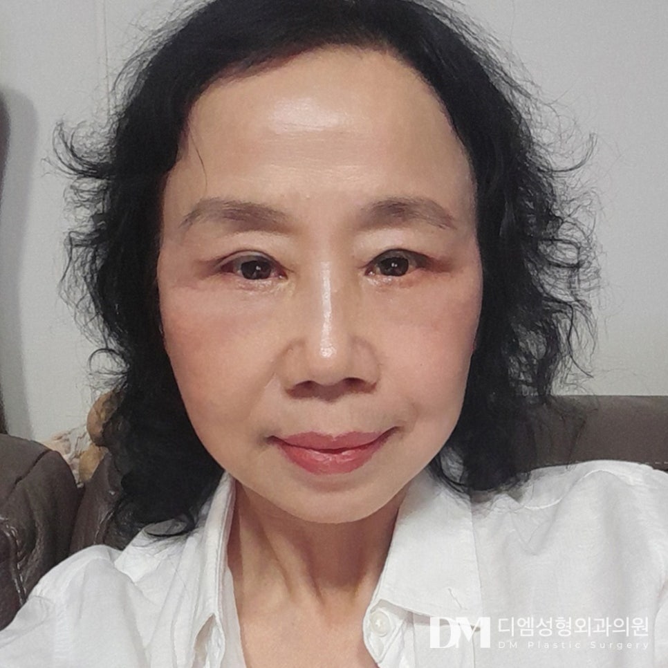 불룩 칙칙한 눈밑이 고민이라면? 관련 이미지 1
