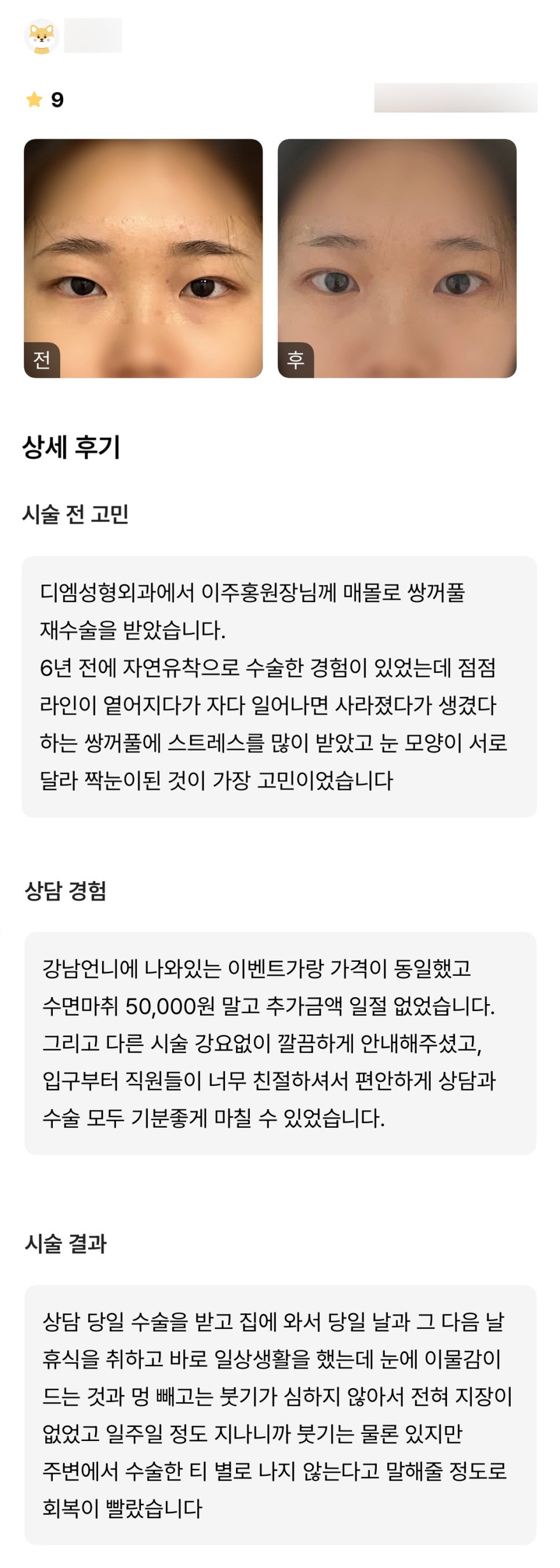 눈재수술 후기."주변에서 수술한 티 별로 나지 않는다고 말해줄 정도로 회복이 빨랐습니다." 관련 이미지 1