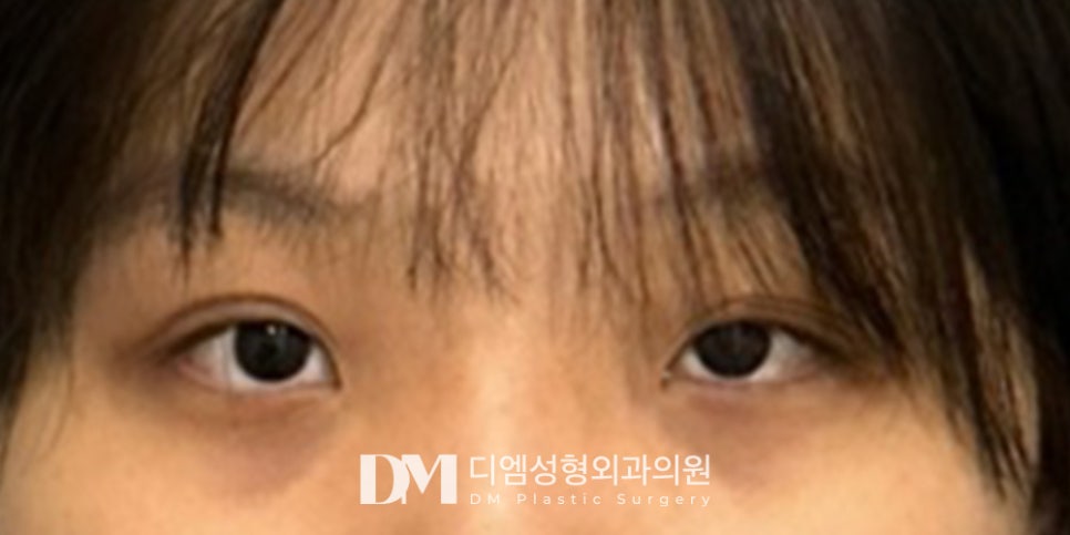 겹주름이 져 피곤한 인상으로 보인다면? 관련 이미지 10