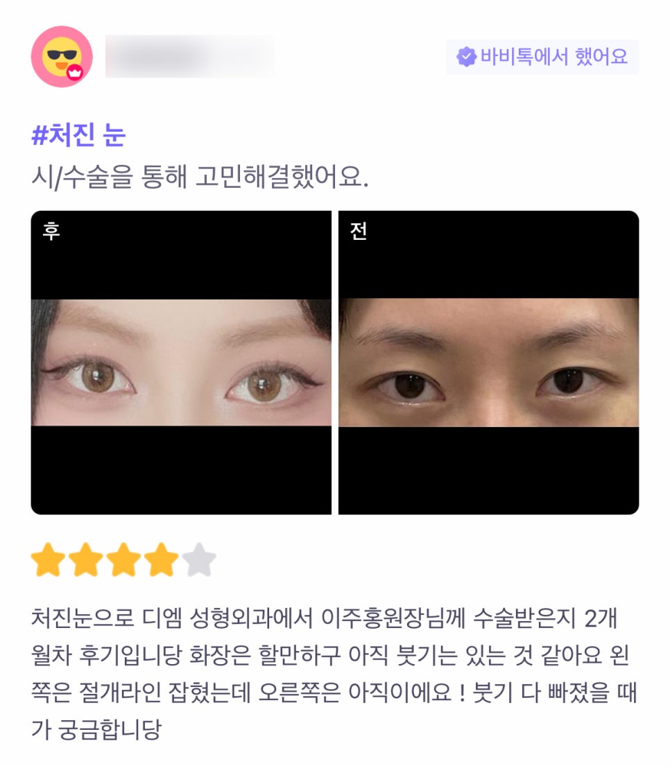 눈재수술 후기."붓기 다 빠진 모습이 궁금해요!" 관련 이미지 1