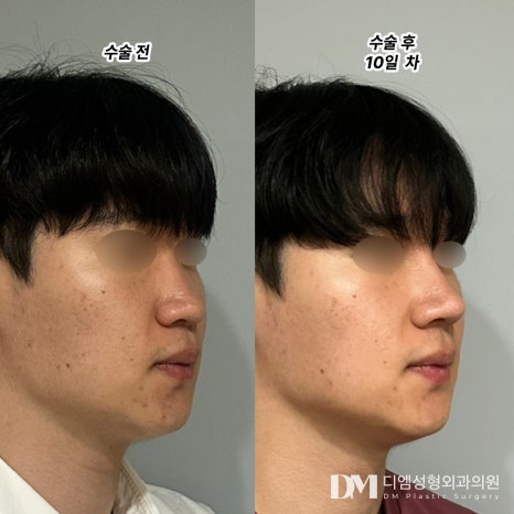 복코성형, 뭉툭한 인상 개선하기 관련 이미지 11