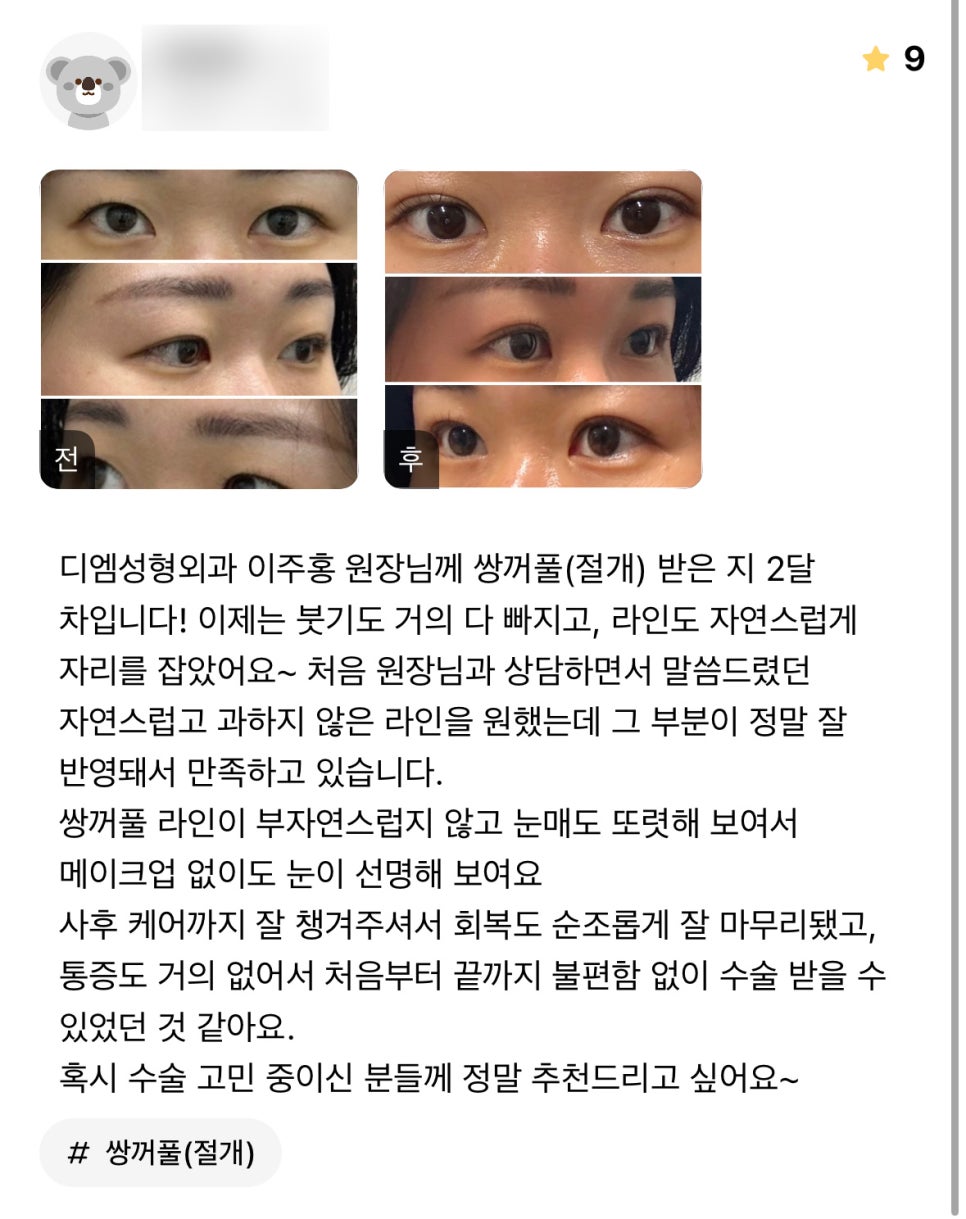 Double-Eyelid Surgery Review: “My Eyes Look Defined Even Without Makeup!” image 1