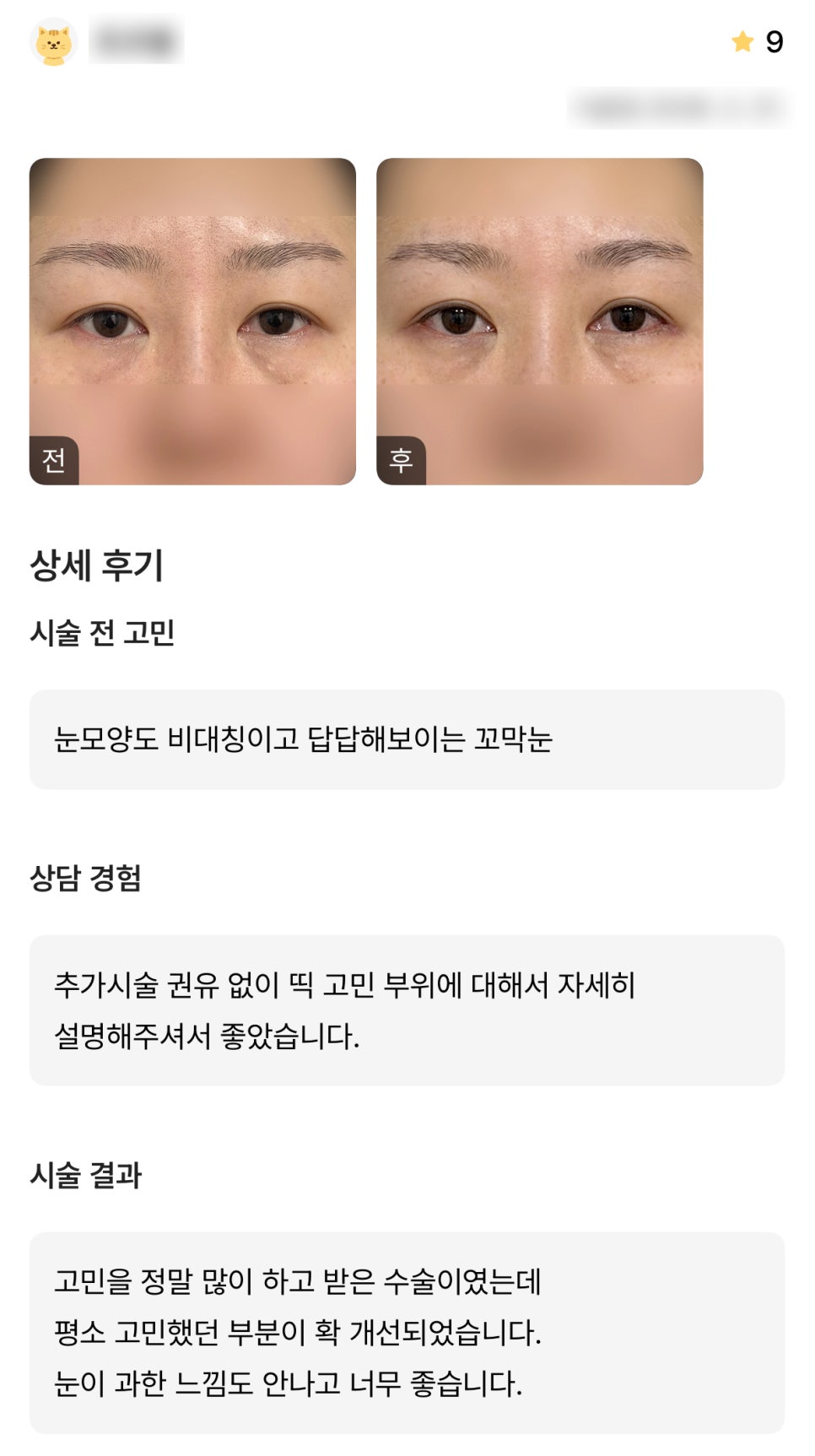 디엠 빵트임 수술후기, &ldquo;고민이었던 부분이 확 개선되었습니다!&rdquo; 관련 이미지 1