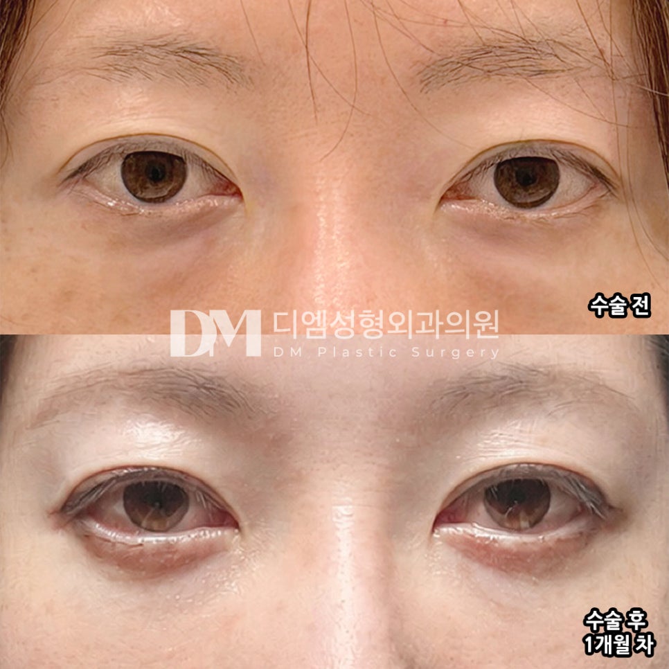 디엠 눈밑지방재배치/눈밑지방이식 수술후기, “자연스럽게 된 것 같아서 만족스러워요!” 관련 이미지 2