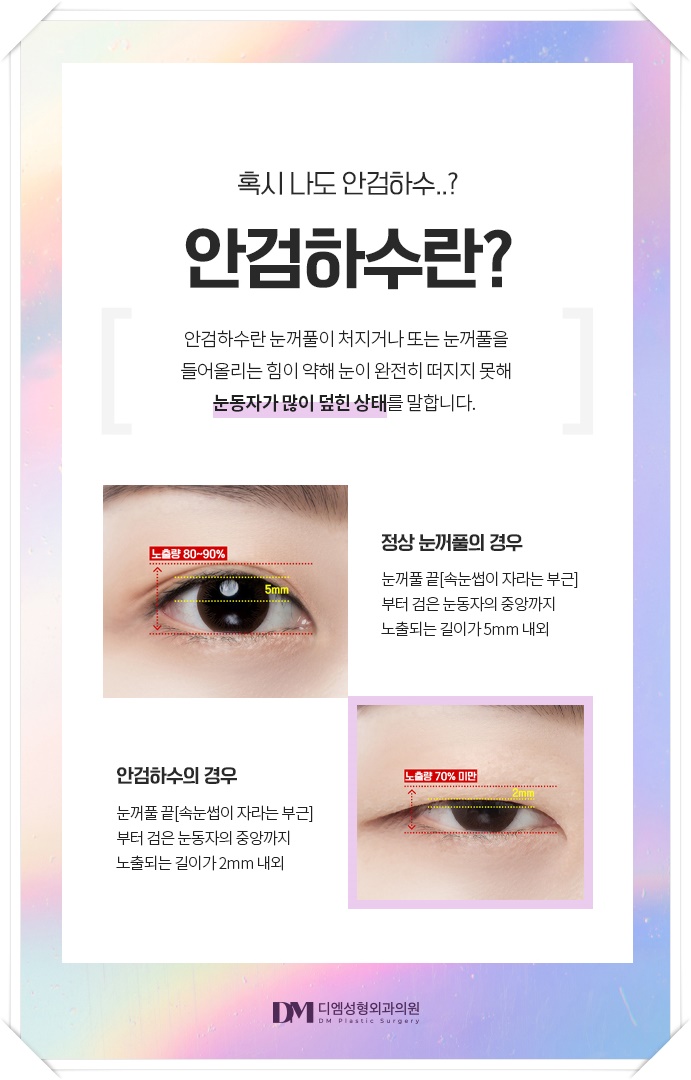 눈매교정, 피곤해보이는 인상 탈출하기 관련 이미지 3