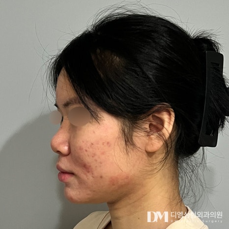 얼굴에 맞는 조화로운 코 끝 성형, 실패하지 않으려면? 관련 이미지 8