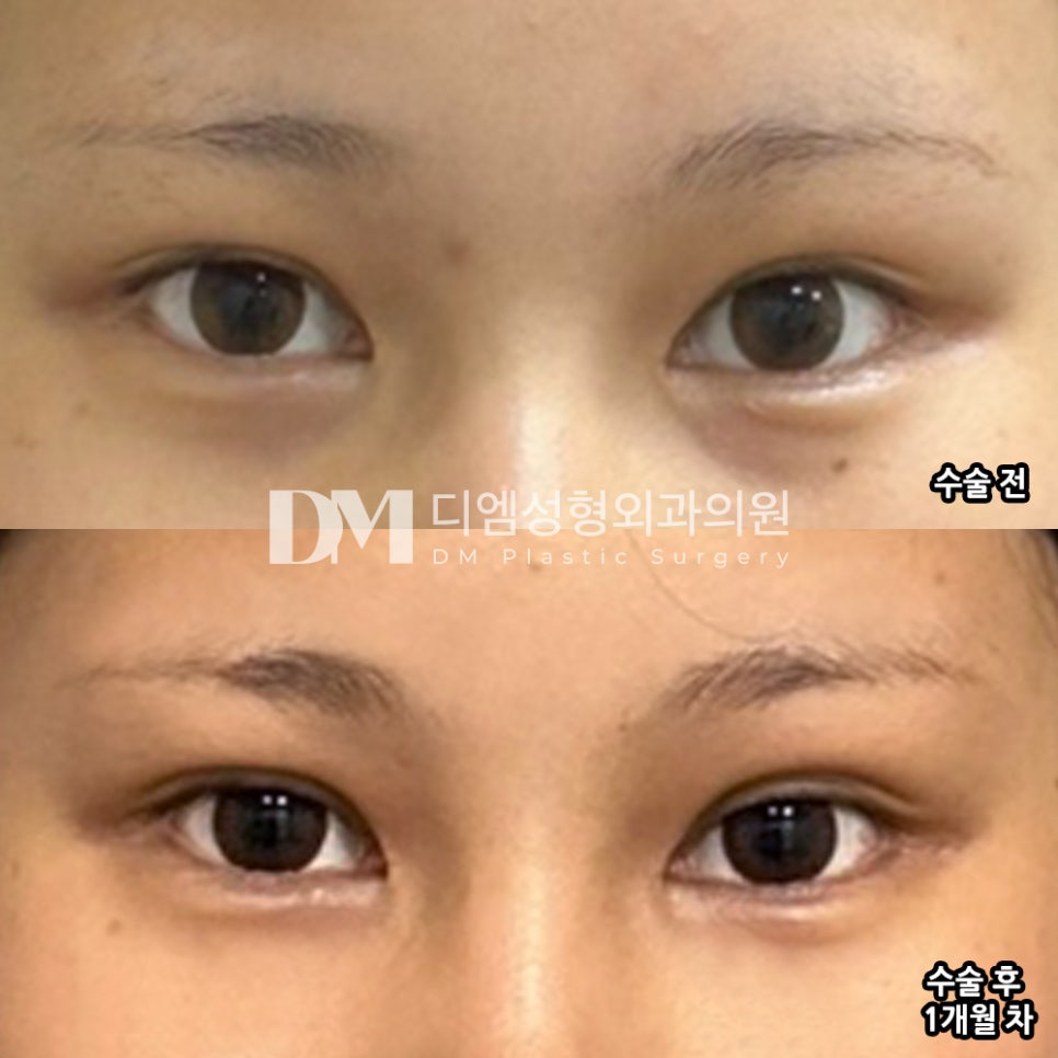 눈재수술 후기." 눈매가 예전에 비해 많이 시원해진 것 같아요 ! " 관련 이미지 2