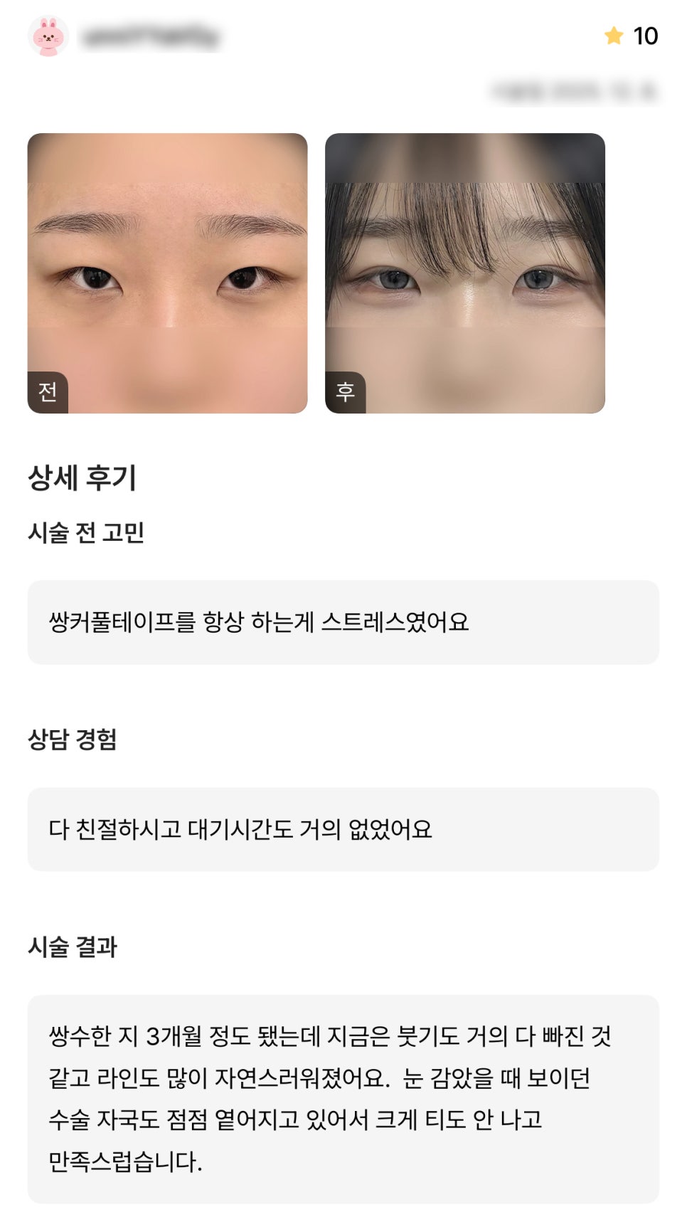 DM Eyelid Correction / Eye Surgery Review, “The swelling seems to have almost completely gone down, and the line has become much more natural!” image 1
