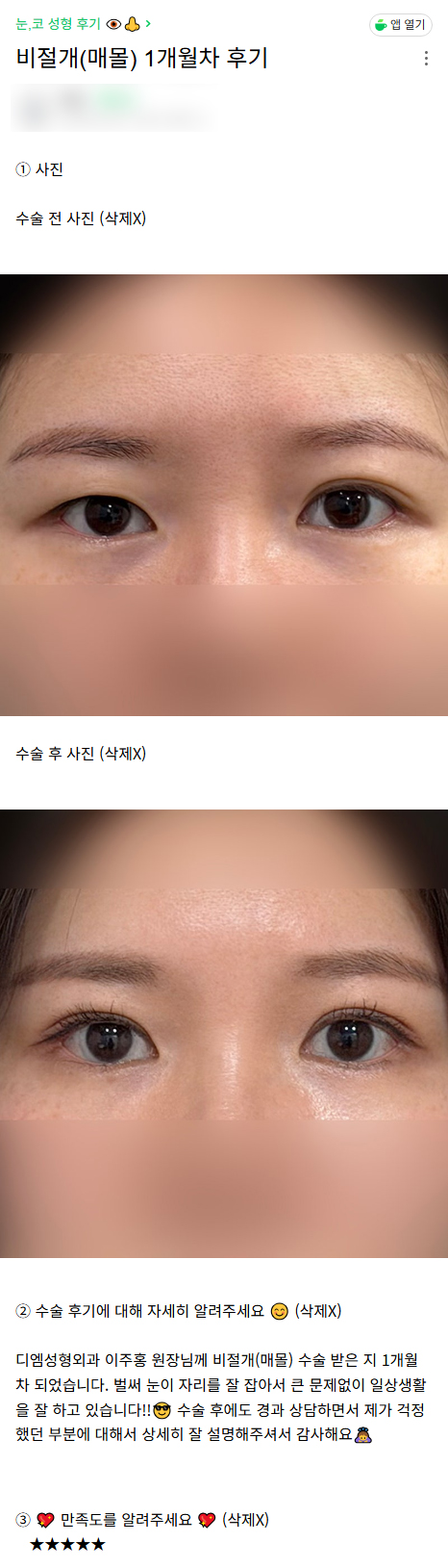 DM Double Eyelid/Eye Plastic Surgery Review, “Everything has settled well, so I’m going about my daily life without any problems!” image 1