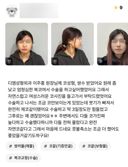 코성형 후기."주변에서 자연코 같다고 해서 마음에 들어요!" 관련 이미지 1