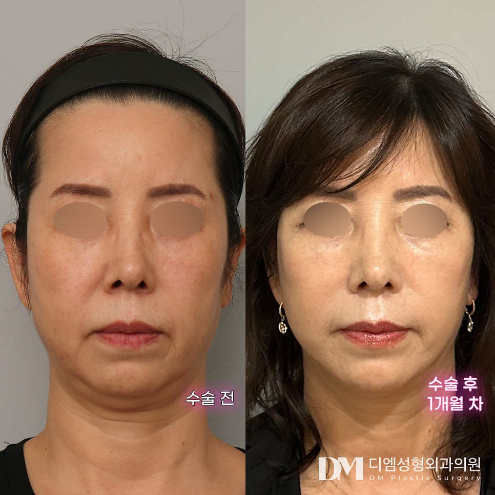 안면거상 후기."정말 추천해 드리고 싶은 병원입니다!" 관련 이미지 2