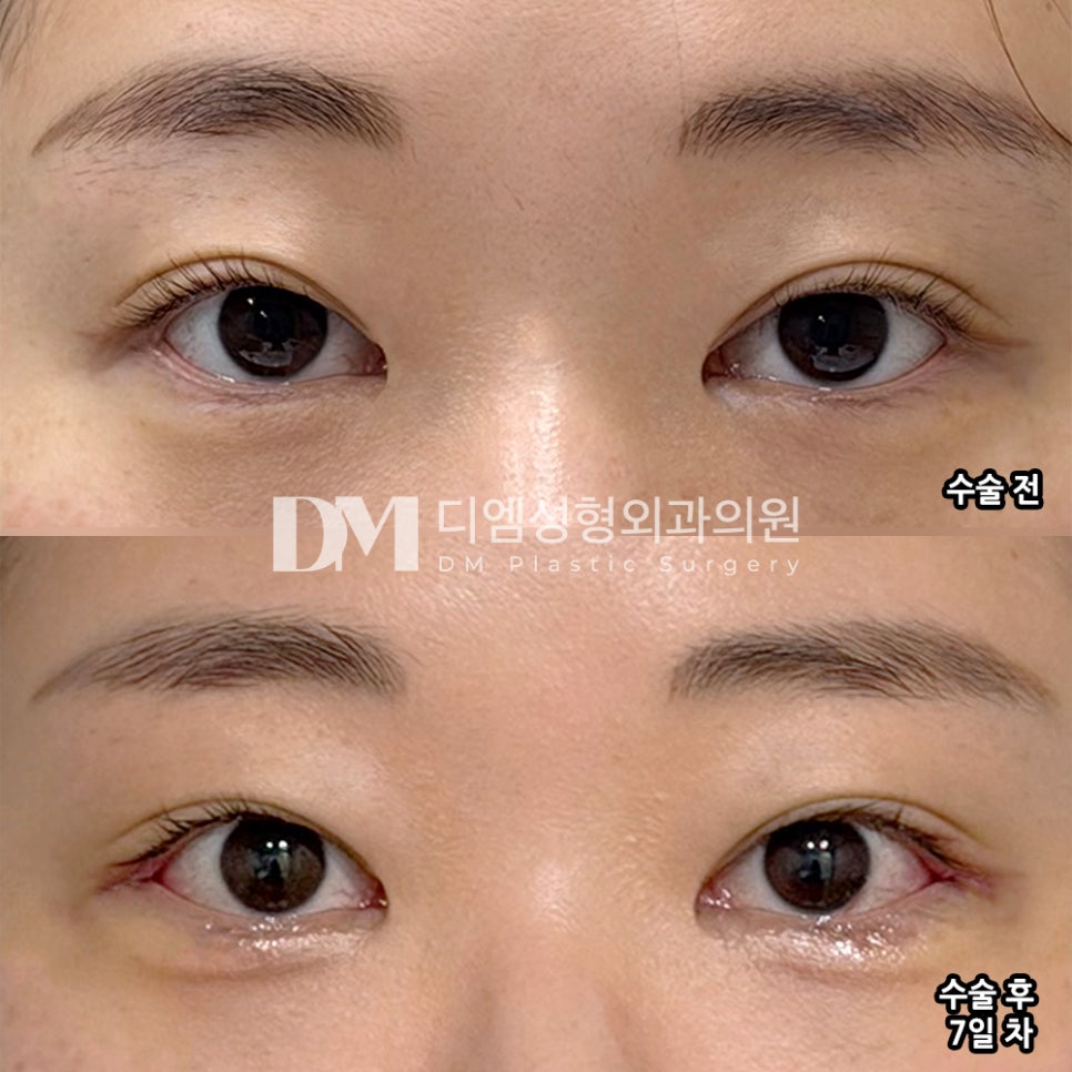 디엠 뒤밑트임 수술후기, “가능한 범위 내에서 최대한 트여주세요!” 관련 이미지 2