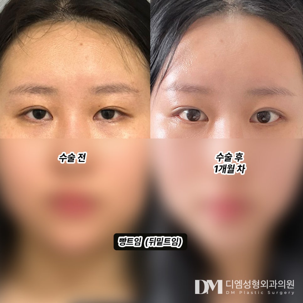 뒤밑트임, 자연스럽게 시원한 눈매로 관련 이미지 5