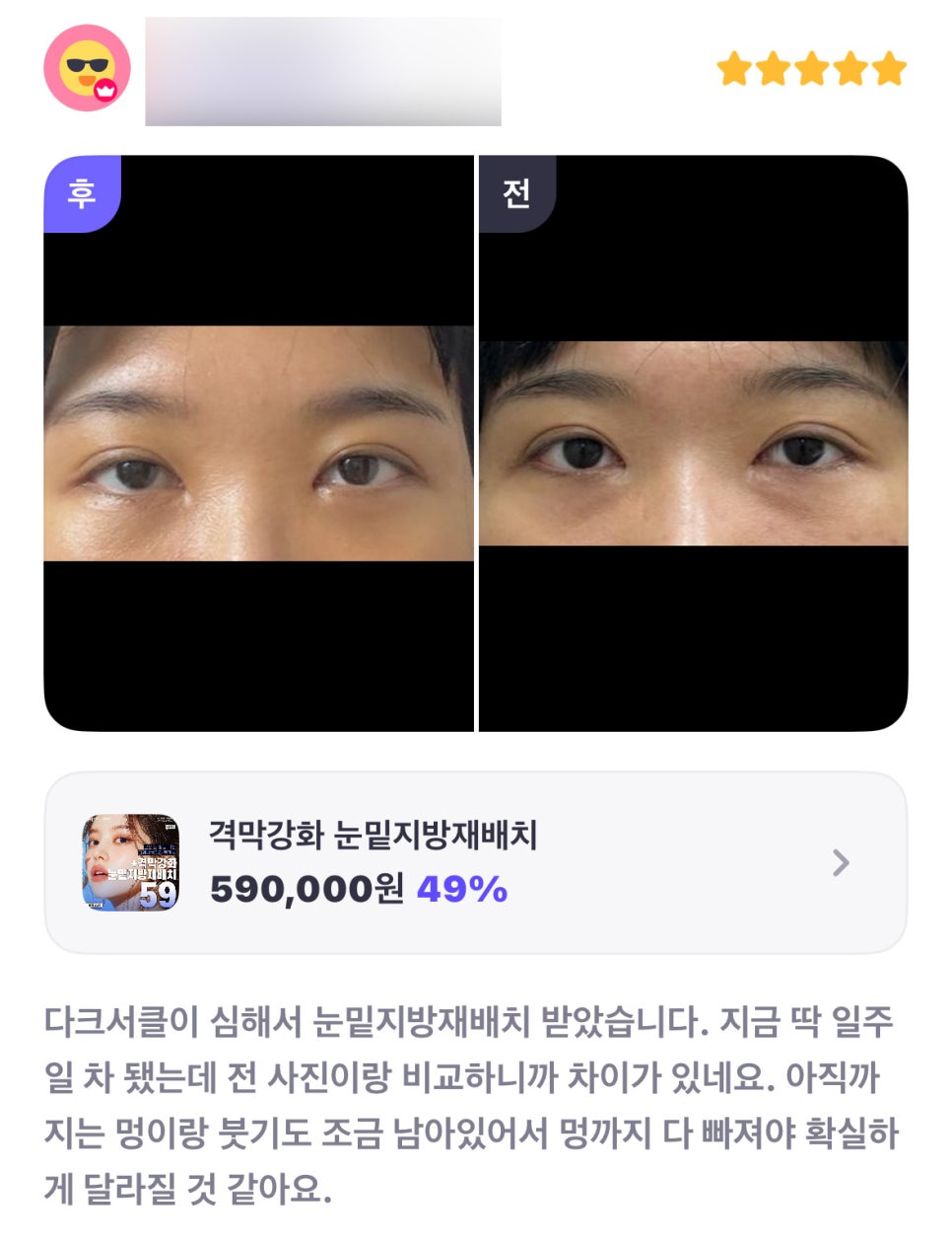 눈밑지방재배치 후기."벌써 변화가 느껴져요!" 관련 이미지 1
