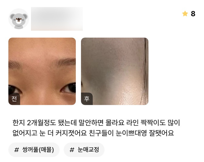 눈성형 후기."친구들이 눈 이쁘대요!" 관련 이미지 1