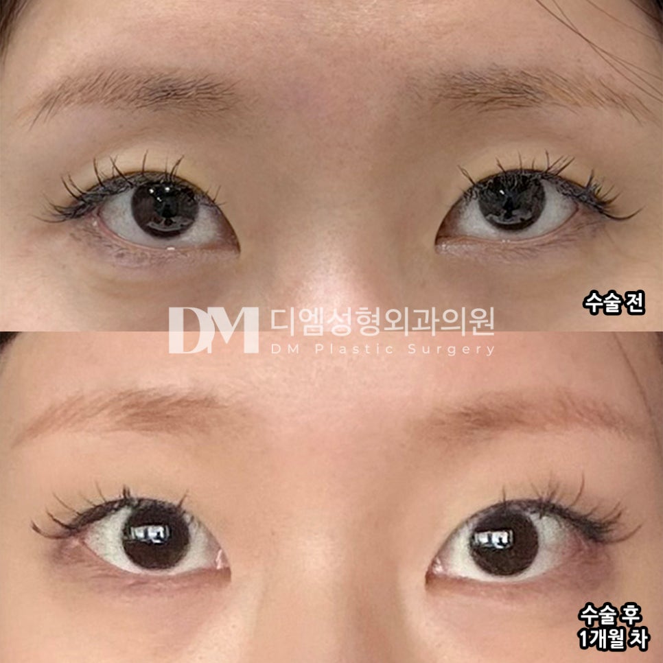 DM Lateral and Lower Canthoplasty Surgery Review, “I’m Happy That My Eyes Look More Open Even After Applying Makeup!” image 2
